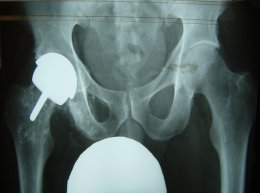 roger tillman knee surgery solihull birmingham hip